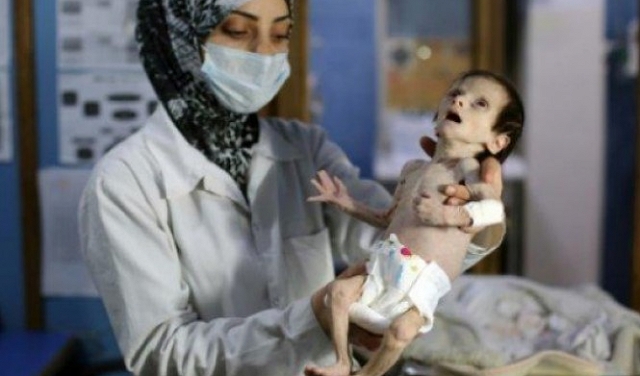 سورية: 1100 طفل يعانون سوء تغذية حاد في الغوطة الشرقية المحاصرة