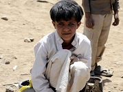 اليمن: سوء التغذية يهدد 400 ألف طفل بالموت
