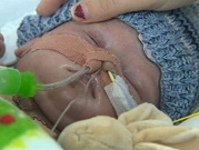 نجاح أول عملية زراعة قلب لرضيع عمره 8 أشهر