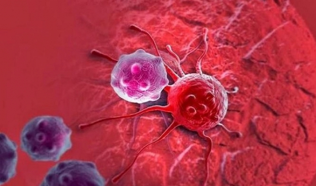 دراسة: أمراض اللثة تزيد فرص الإصابة بالسرطان