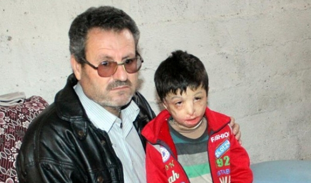 محمود... طفل سوري أحرقته براميل النظام وينتظر العلاج