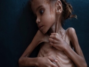 اليمنية أمل حسين: ضحية الجوع والمرض والحرب
