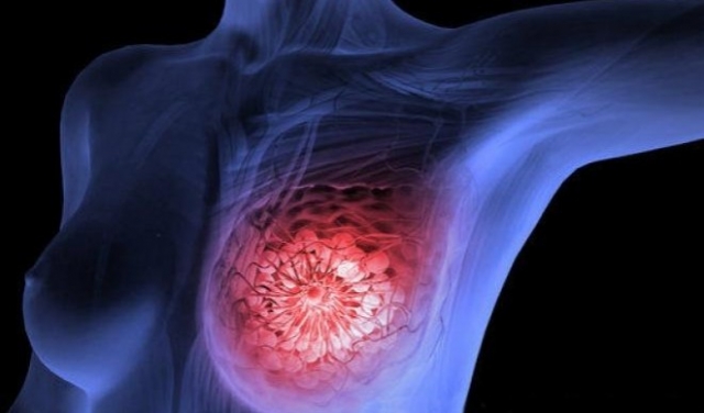 تصوير الأشعة المنتظم للثدي يقلل خطر السرطان بـ60%
