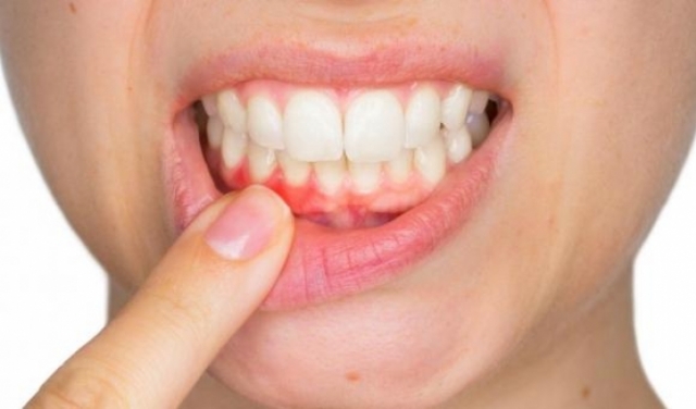 بكتيريا تنتقل من الفم للمخ... العناية بالأسنان تُجنّبك الزهايمر