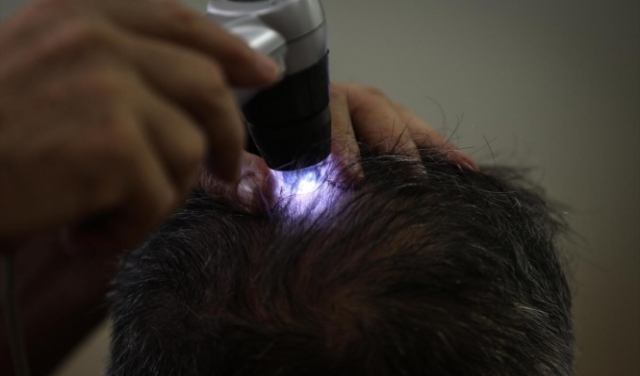 شركة تركية تقترب من ابتكار علاج لتساقط الشعر