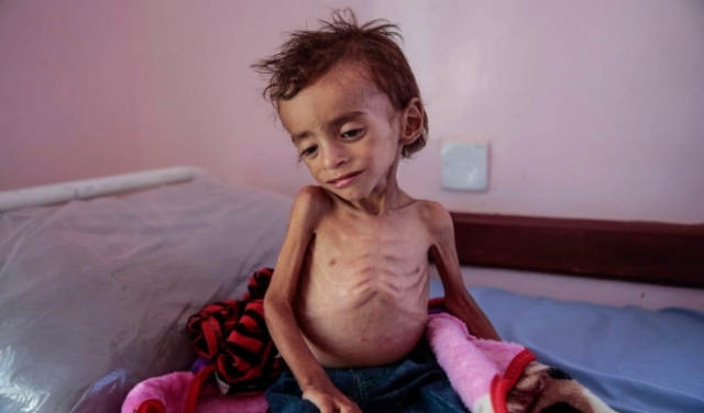 الصحة العالمية: بدون علاج... السرطان حكم بإعدام 35 ألف يمني