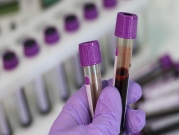 تطوير فحص دم بسيط للكشف عن سرطان البروستاتا 