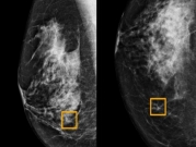 برنامج من "جوجل" يكشف عن سرطان الثدي بدقّة!