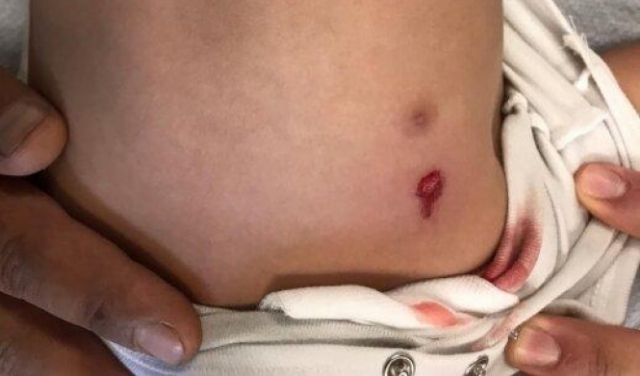 الناصرة: رصاصة طائشة تصيب طفلا خلال لعبه مع شقيقته