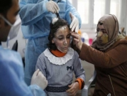 مرام العماوي: طفلة من غزة تخفي حروقها خلف قناع ثلاثي الأبعاد