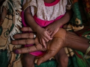 تيغراي: سوء التغذية الحاد يضرب الأطفال دون الخامسة