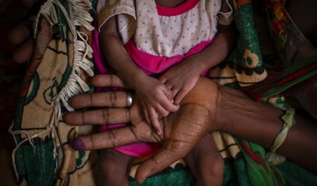 تيغراي: سوء التغذية الحاد يضرب الأطفال دون الخامسة