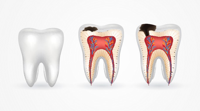 أنواع تسوس الأسنان