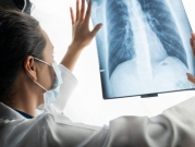 بحث يكشف العلاقة بين تلوث الهواء وبعض سرطانات الرئة