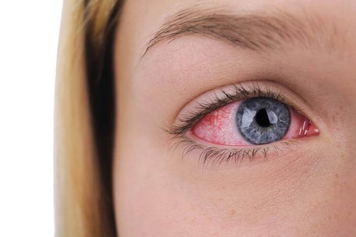 الحساسية تسبب احمرار العين