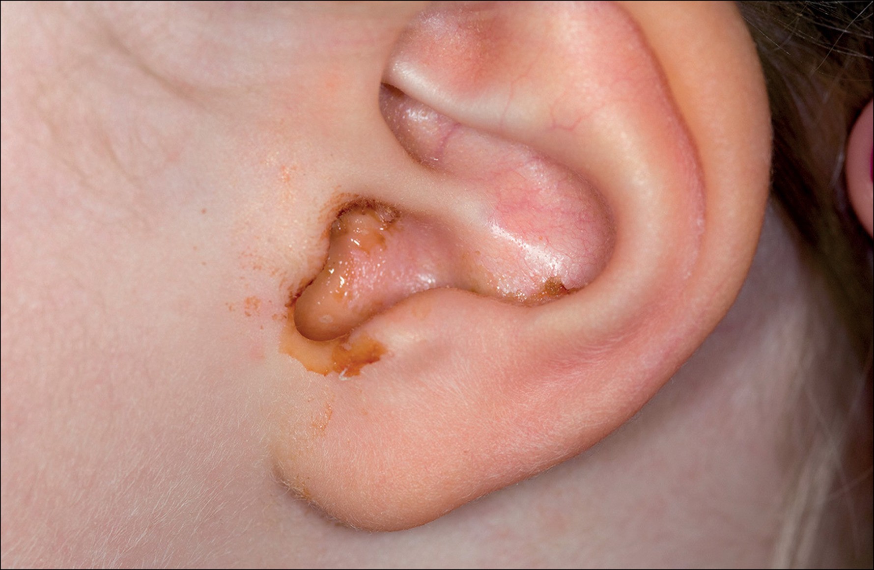 إفرازات من داخل الأذن