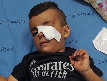 إصابة طفل (4 أعوام) بحروق في هجوم للمستوطنين على مسافر يطا