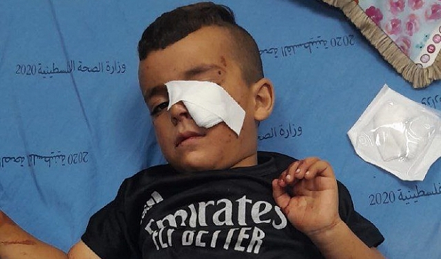إصابة طفل (4 أعوام) بحروق في هجوم للمستوطنين على مسافر يطا