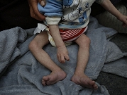  شمالي غزة: استشهاد 4 مواطنين بينهم طفلان بسبب سوء التغذية في مستشفى كمال عدوان
