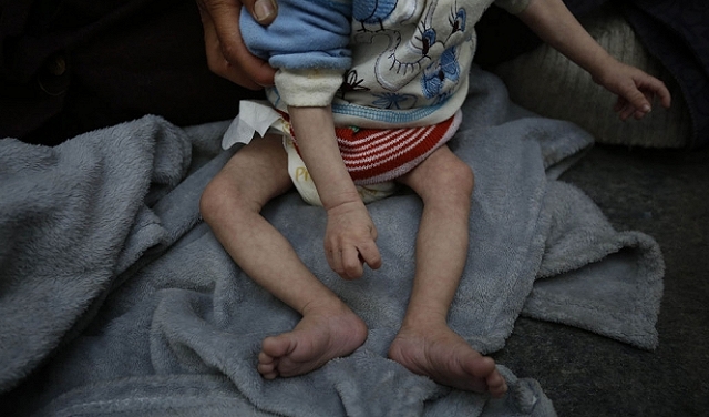  شمالي غزة: استشهاد 4 مواطنين بينهم طفلان بسبب سوء التغذية في مستشفى كمال عدوان