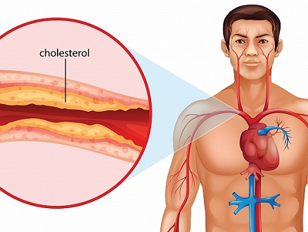 دليلك الشامل عن الكوليسترول في الدم وكيف نستطيع ضبط مستوياته ضمن الحدود الطبيعية