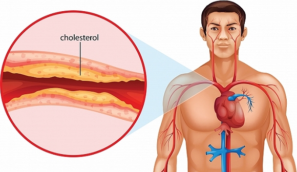 دليلك الشامل عن الكوليسترول في الدم وكيف نستطيع ضبط مستوياته ضمن الحدود الطبيعية